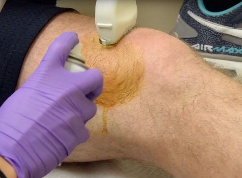 video explaining what to expect with orthobiologic injections