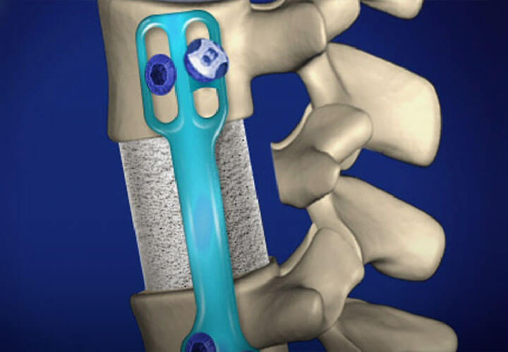 Spine Surgeries | OrthoIndy | Orthopedic Care at OrthoIndy